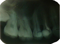 radiografie dentara IV