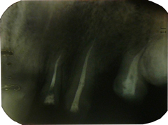 radiografie dentara II