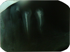 radiografie dentara III